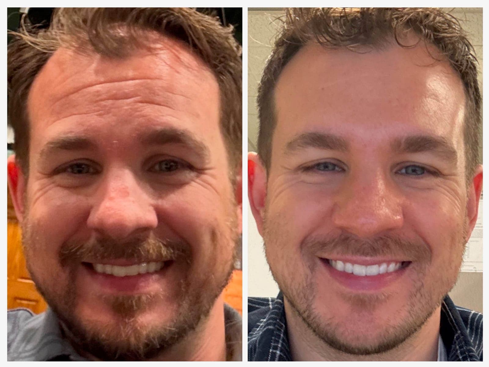 Before and after results of Botox treatment for a middle-aged man.