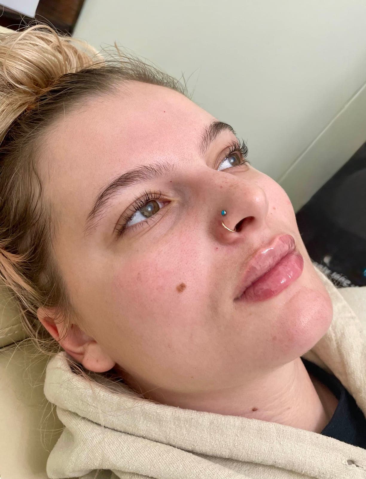 Before and after results of dermal filler treatment in the lips.