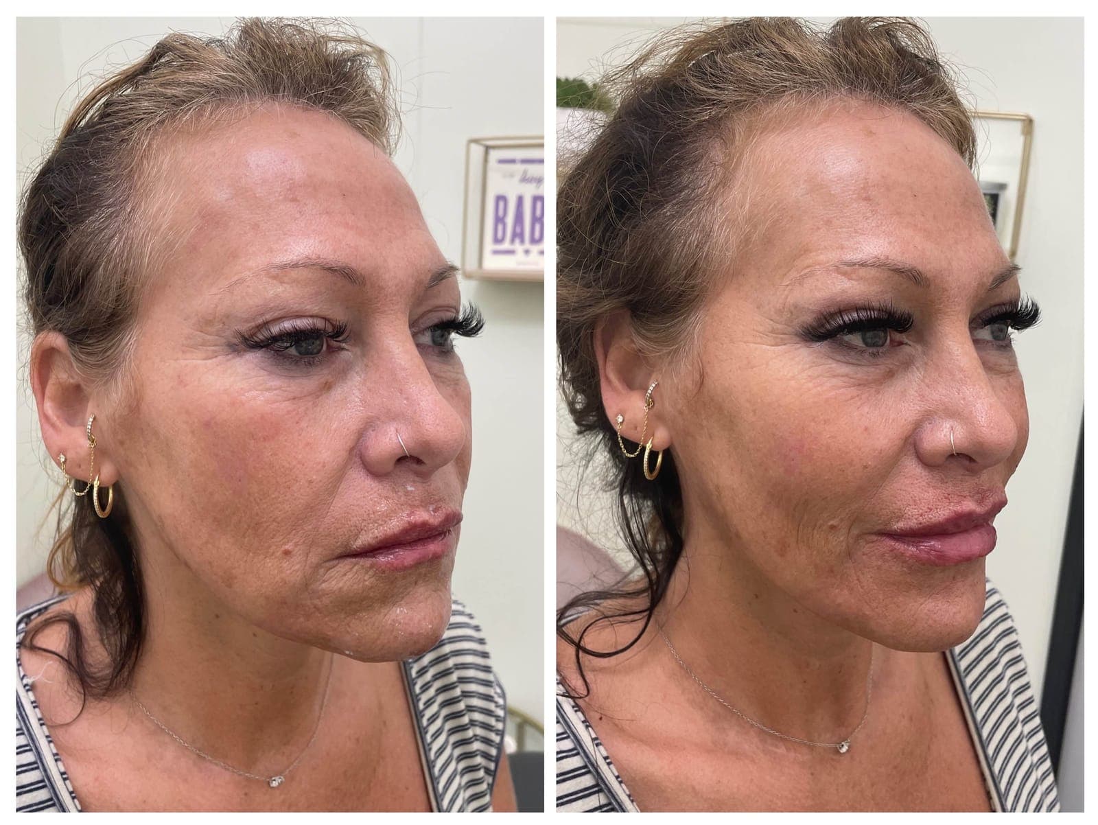 Before and after results of full facial balancing with dermal fillers.
