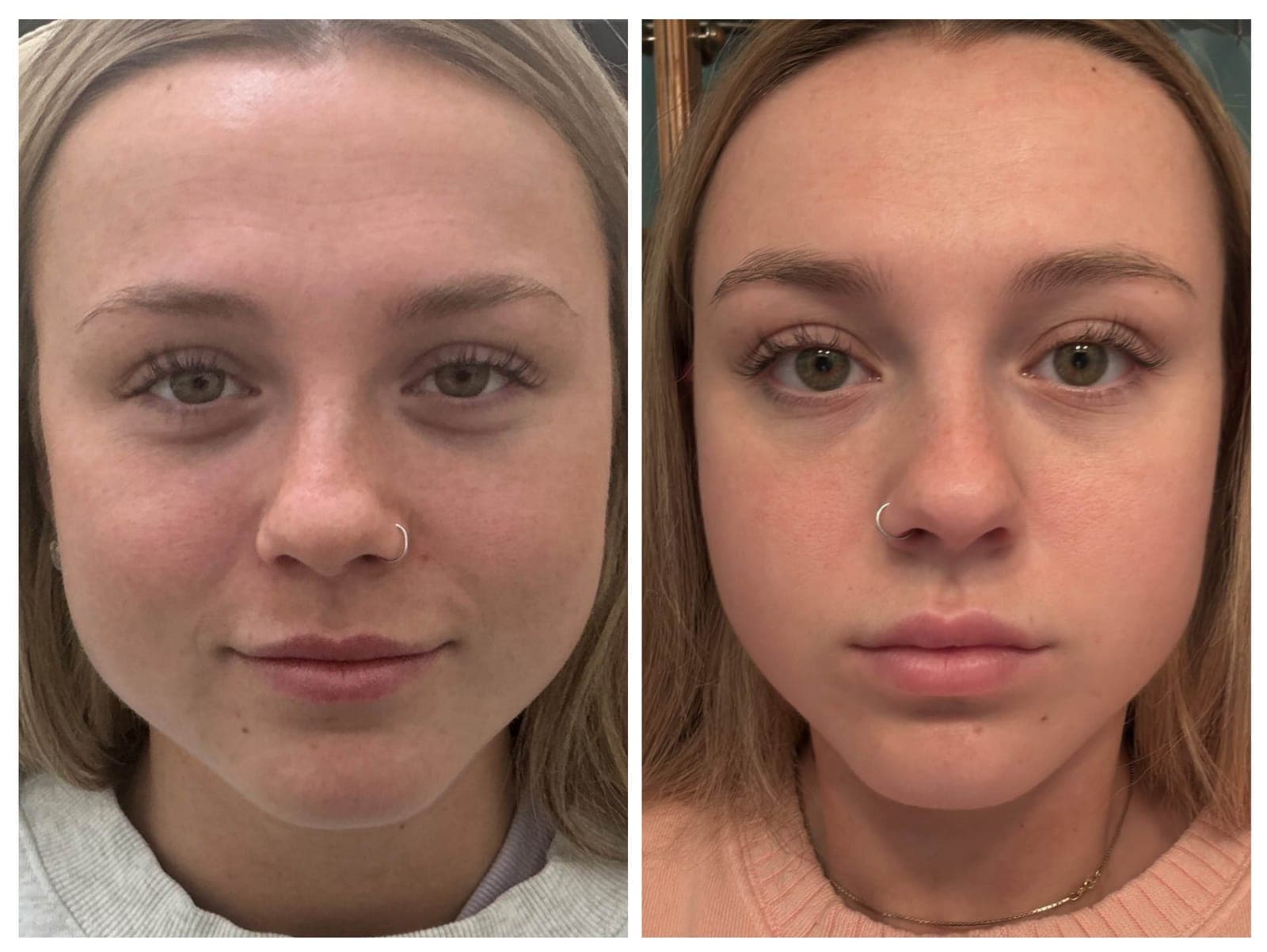 Before and after results of jawline slimming and lip filler treatment.