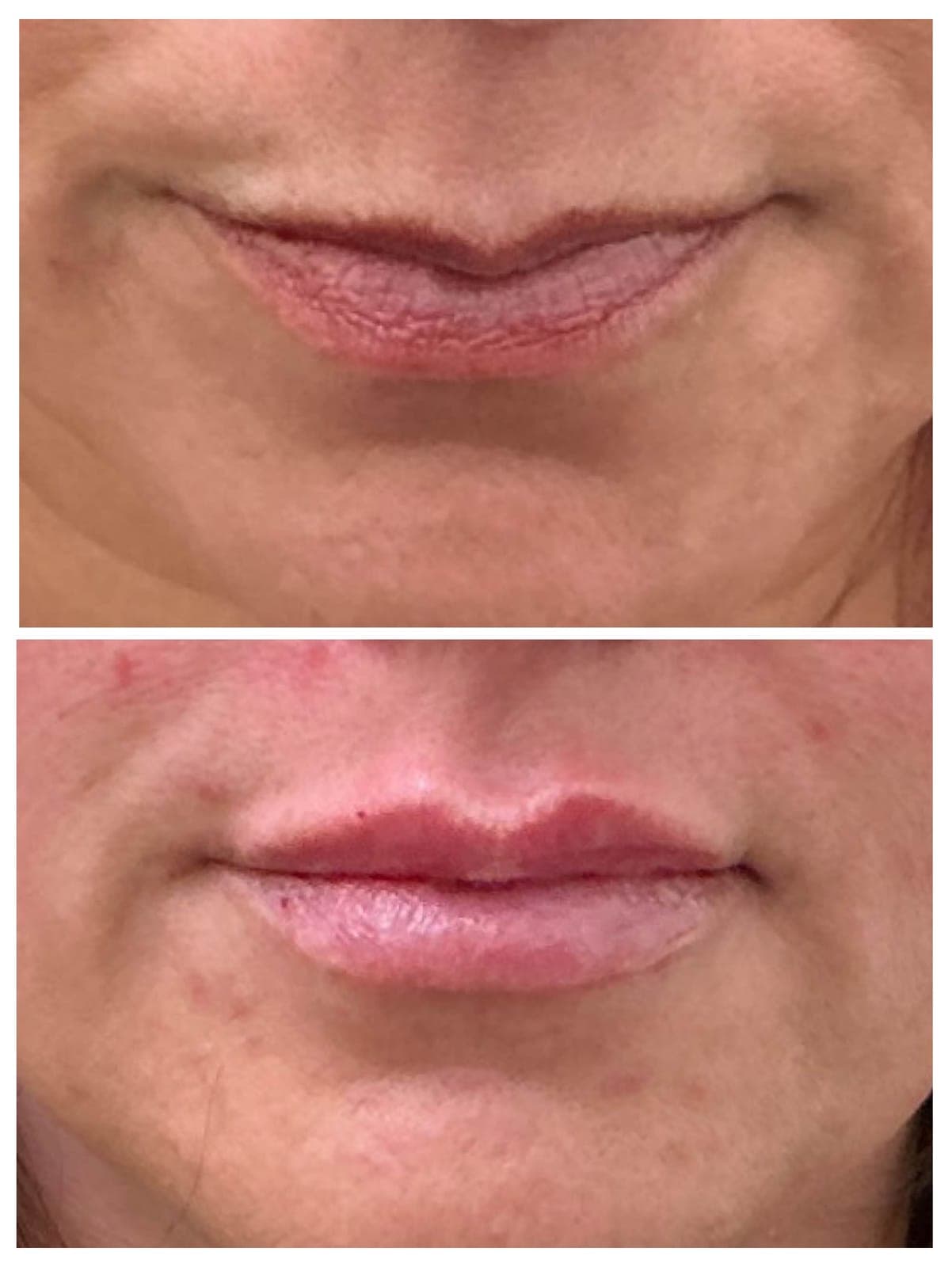 Before and after results of the Juicy Pout treatment, featuring lip flip and filler.