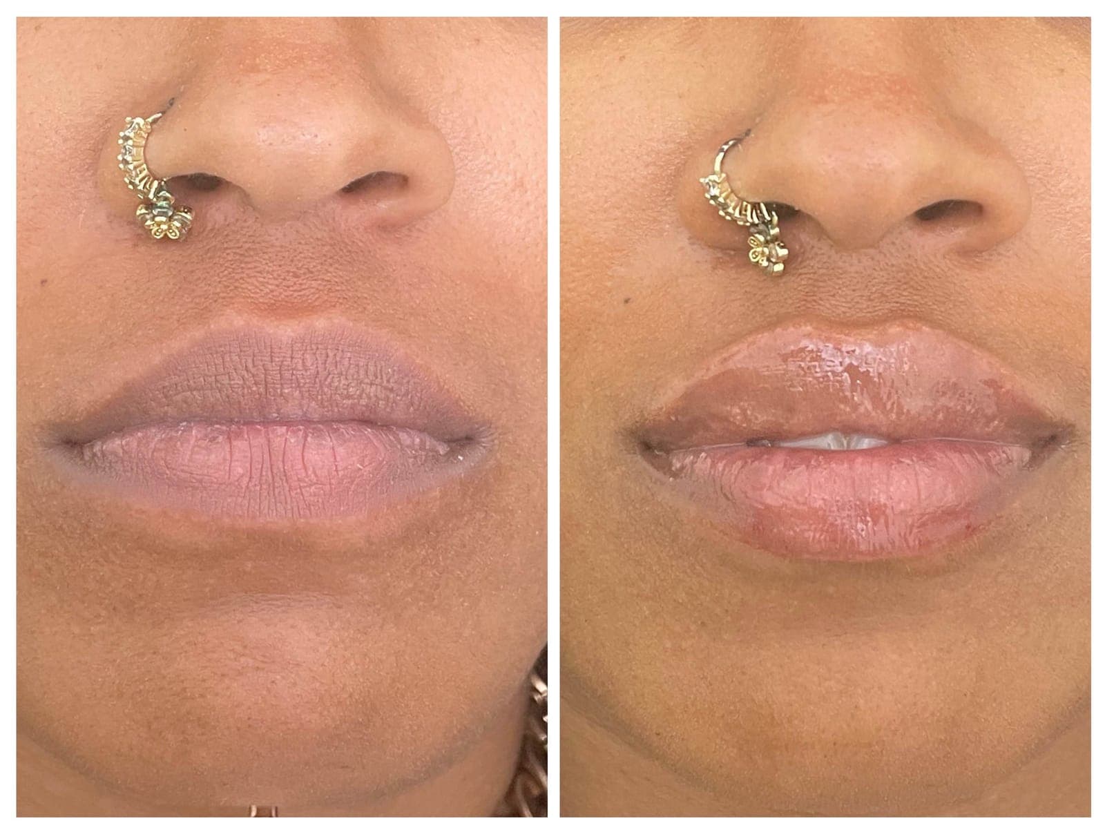 Before and after results of lip enhancement using dermal fillers.