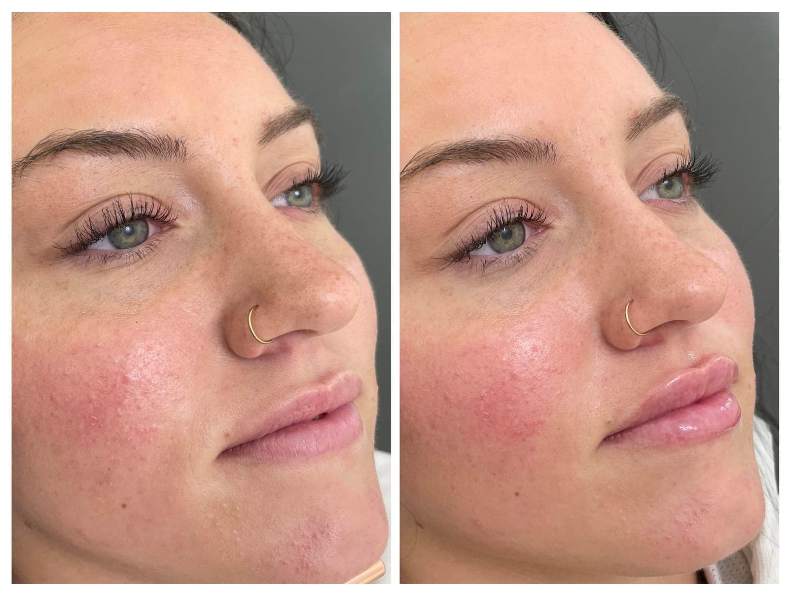 Before and after lip filler treatment