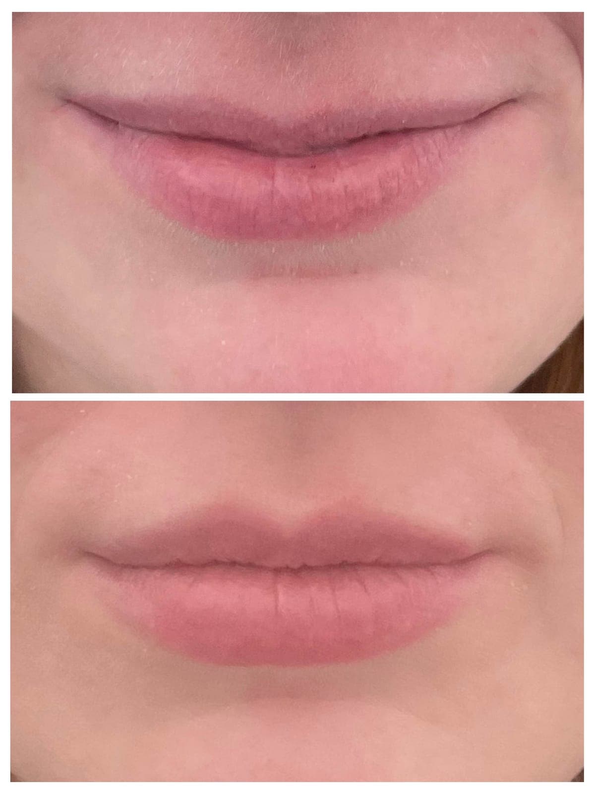 Before and after results of a Botox lip flip treatment.