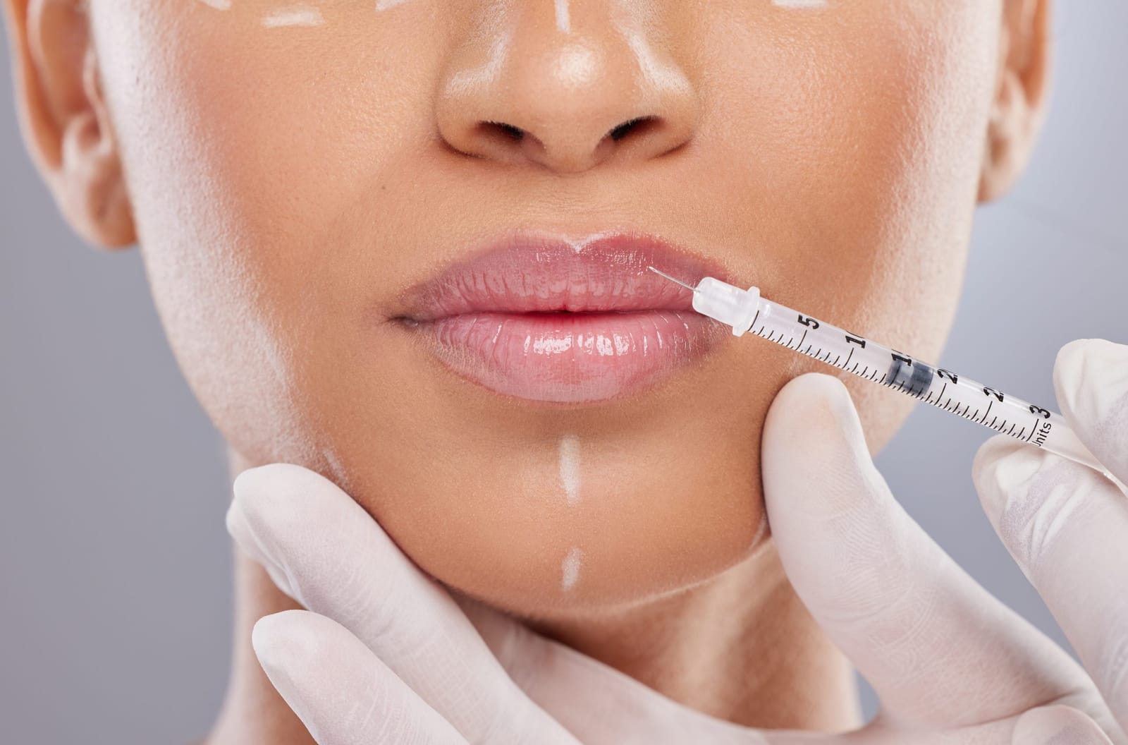 Dermal filler treatment for natural-looking facial volume