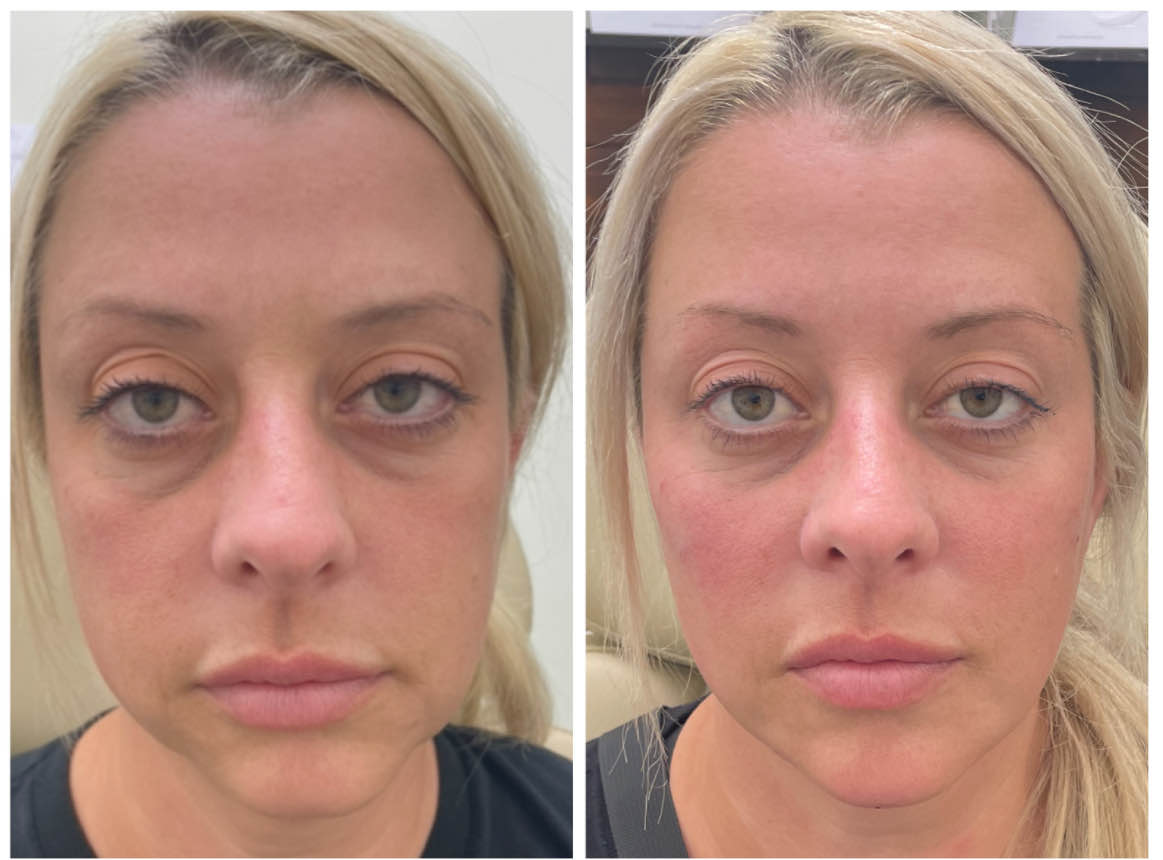 Before and after results of face balancing treatment using filler and neurotoxin at Honeydew Aesthetics.