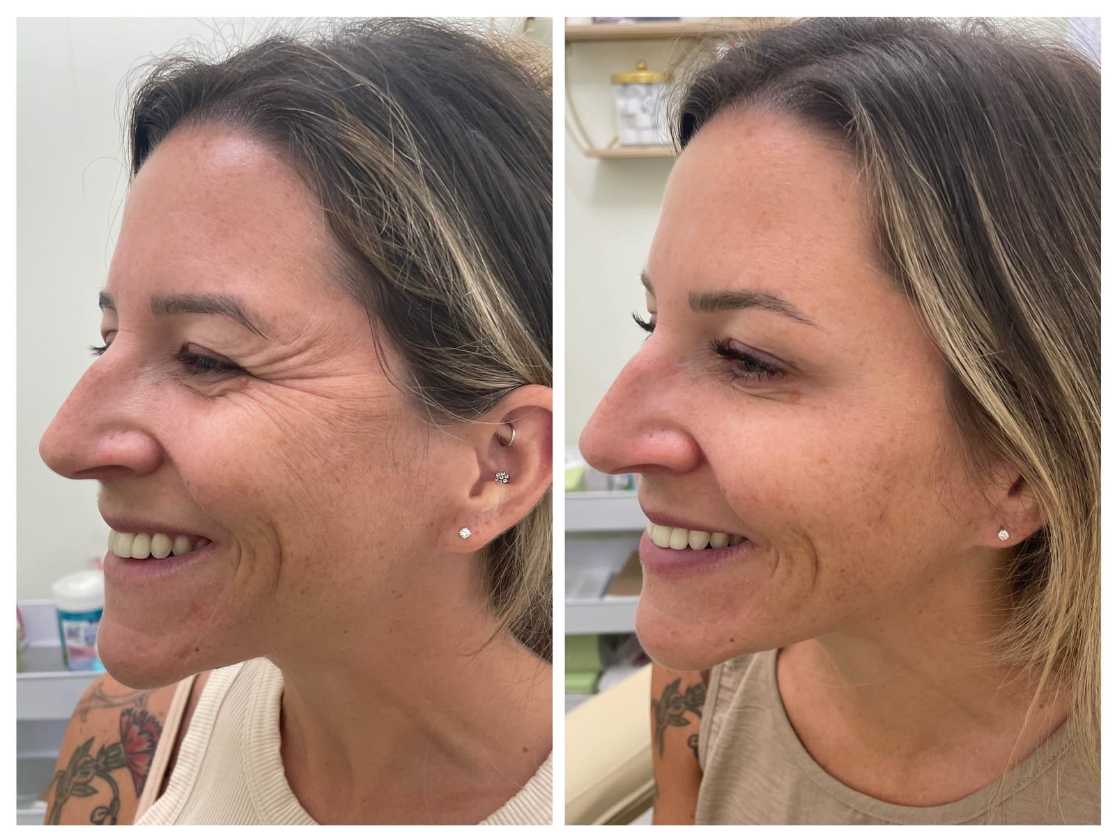 Before and after results of facial neurotoxins treatment for smoothing fine lines at Honeydew Aesthetics.