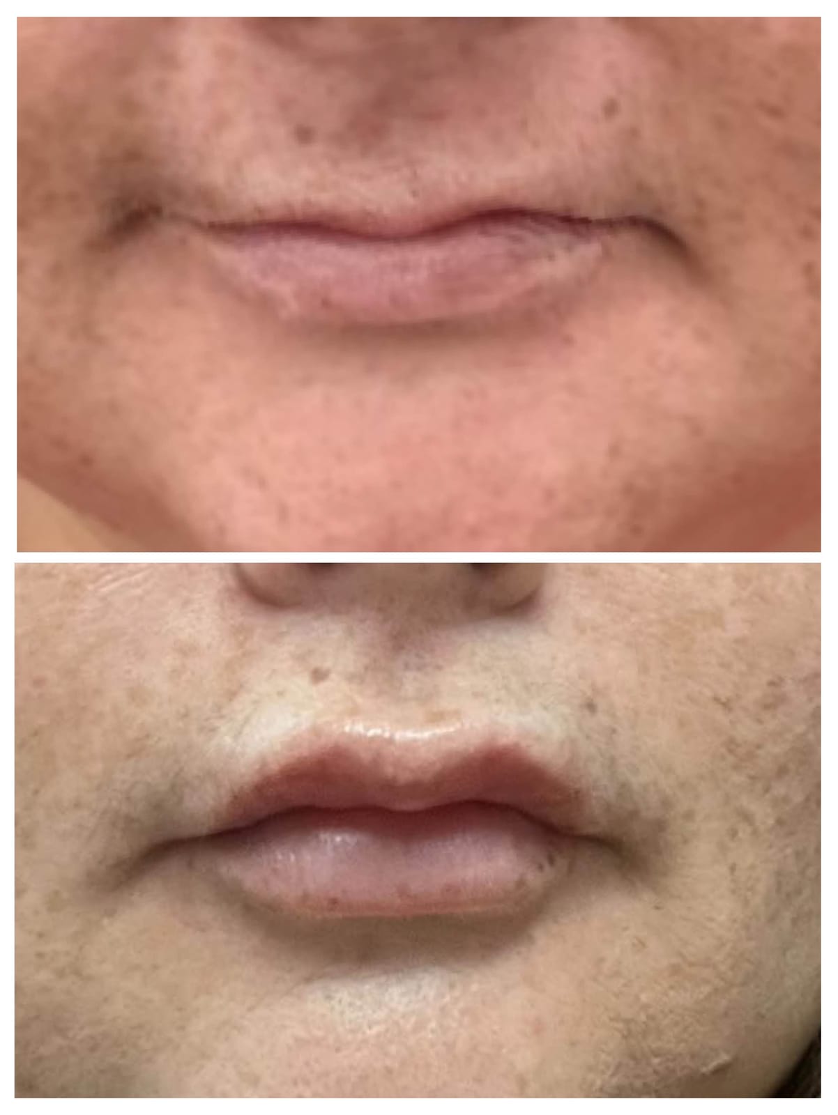 Before and after showcasing the Juicy Pout treatment at Honeydew Aesthetics, featuring a lip flip and filler for enhanced volume.