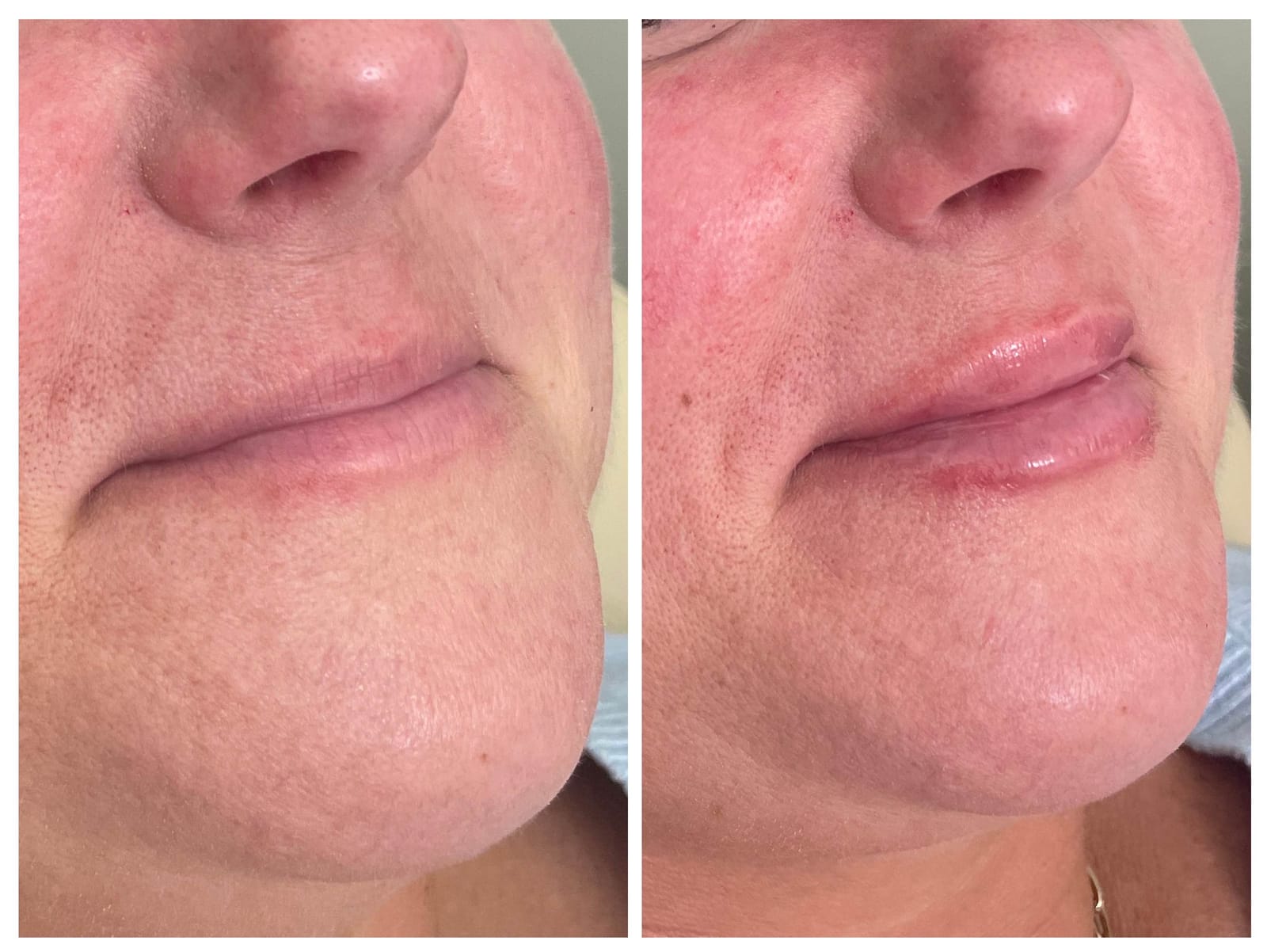 Results of Juicy Pout treatment with a combination of lip flip and filler at Honeydew Aesthetics.