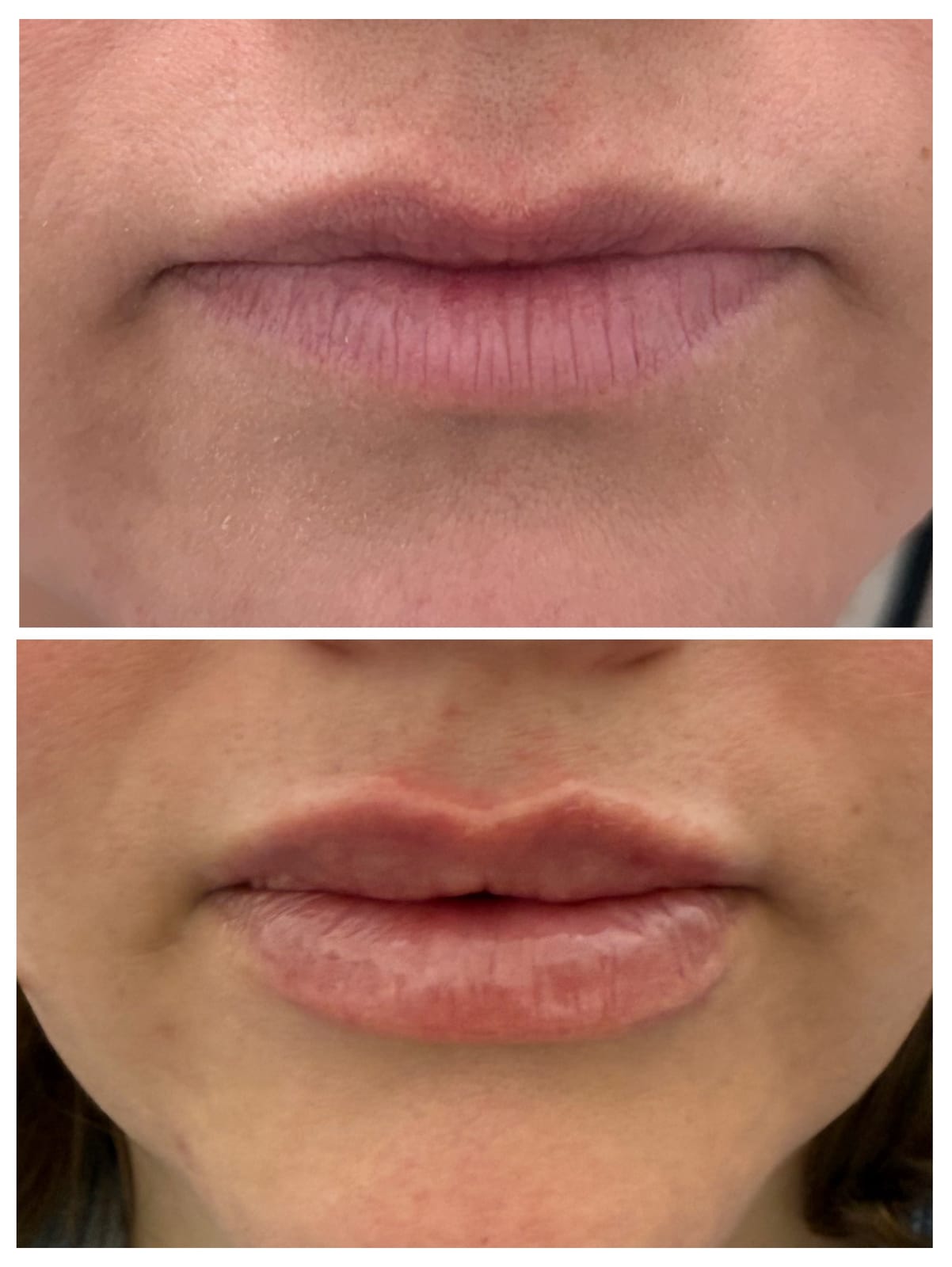 Lip filler before-and-after results by Honeydew Aesthetics, enhancing volume and definition naturally.