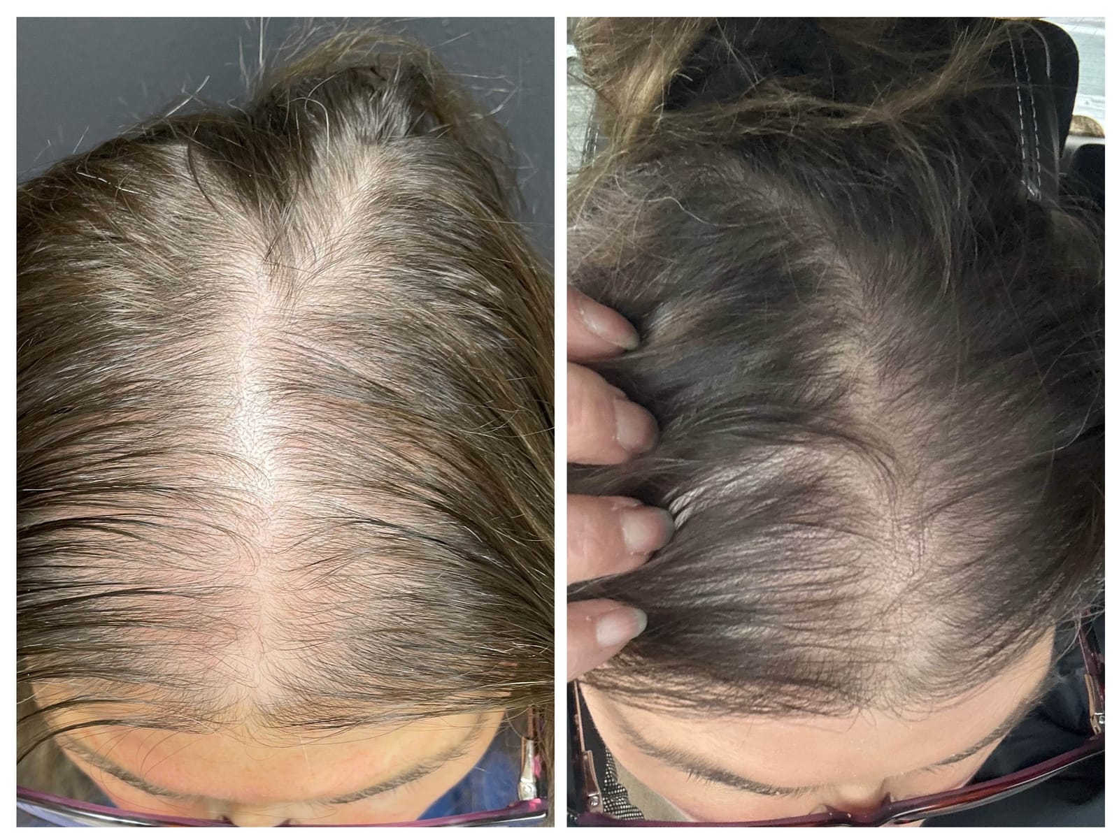 Female hair restoration results after one treatment at Honeydew Aesthetics, showing improved hair density.